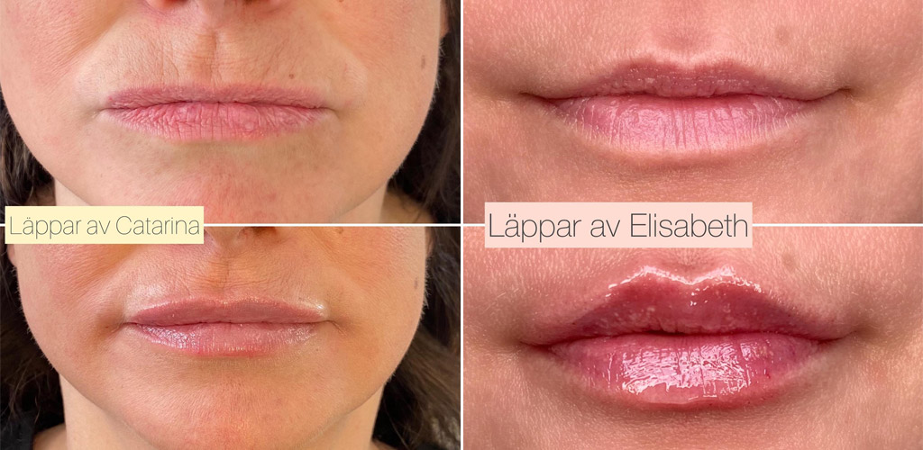 Fillers läppar löfvingkliniken i göteborg