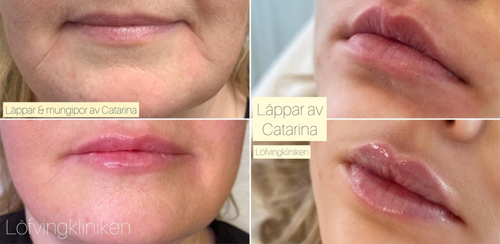 Fillers läppar och mungipor Löfvingkliniken i göteborg